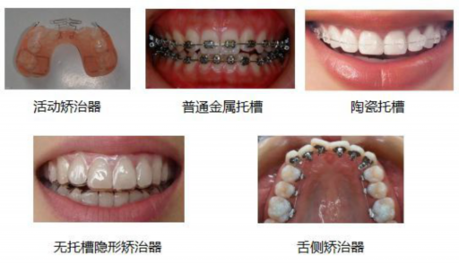 2025上海透明托槽矫正口腔美容医院排行前10位都是技术流派！上海正睿口腔等医院评价高